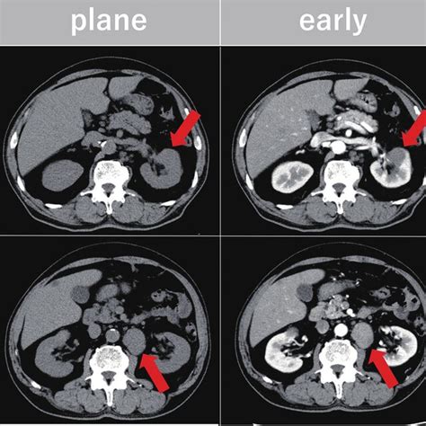 moderate global hypokinesis prognosis.